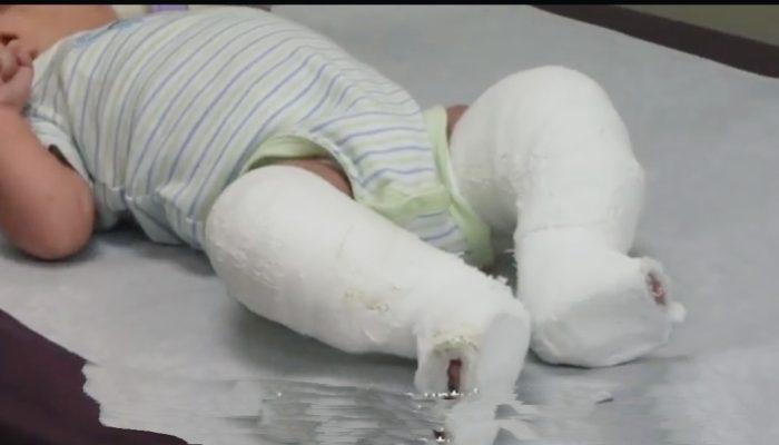 Muhammadiyah Hadirkan Harapan Baru untuk 161 Anak Pengidap Clubfoot